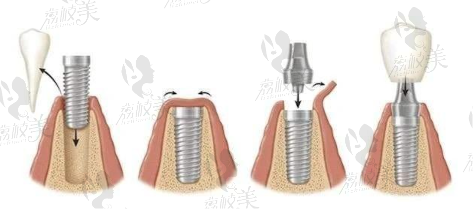 种植牙示意图