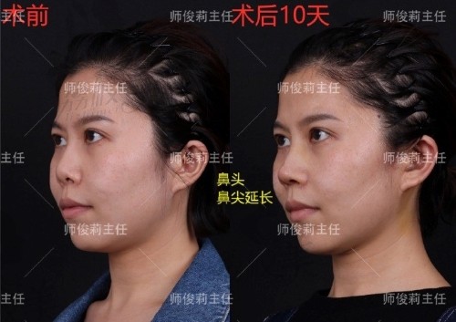 西安国 际医学中心整形医院鼻整形外科主任师俊莉案例图