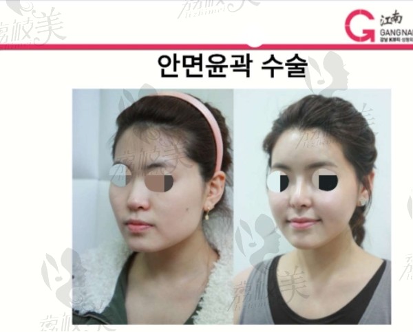 韩国K-Beauty整形外科医院代表院长柳重锡案例3