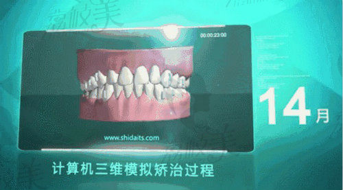 数字化牙齿矫正