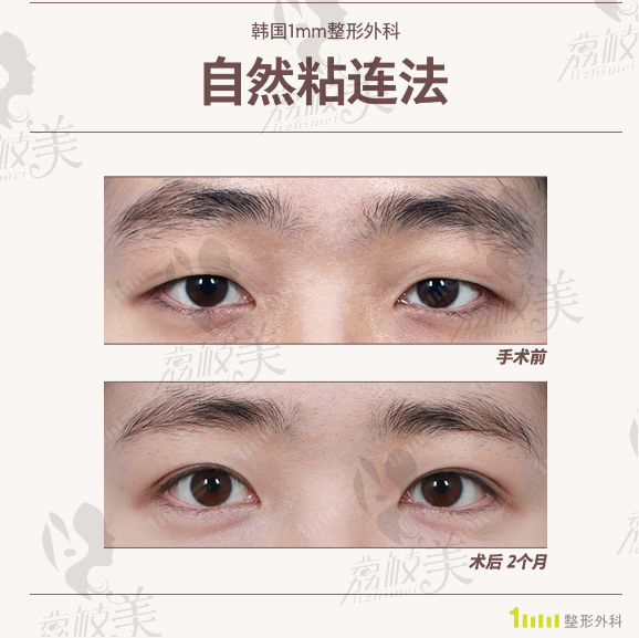 韩国1mm整形外科男士自然粘连法手术案例对比