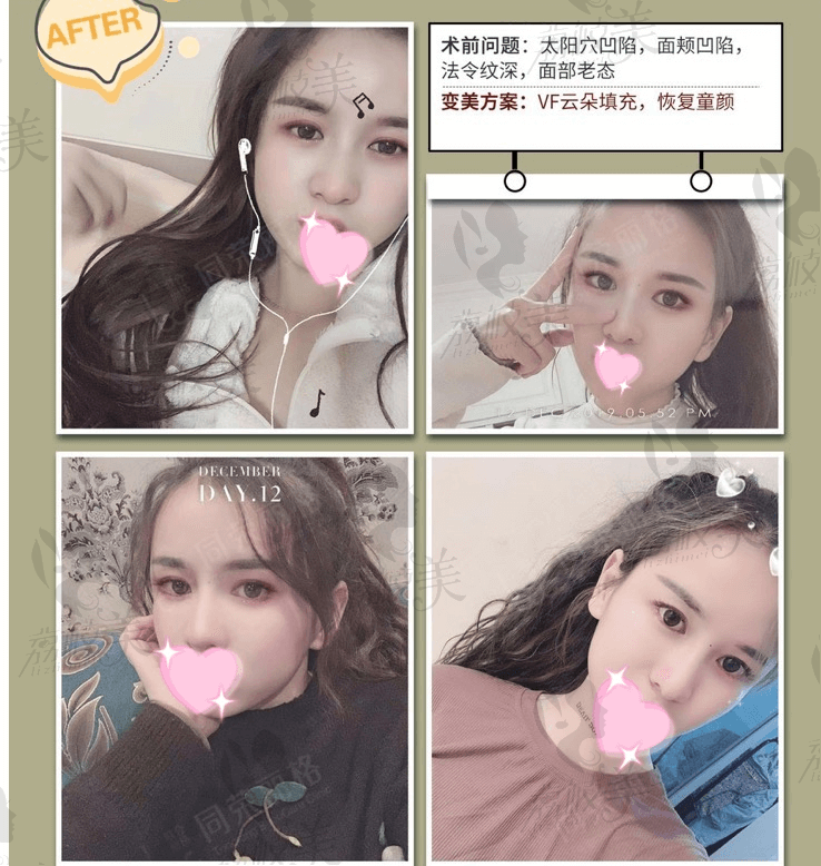 杭州同荣丽格自体脂肪填充案例