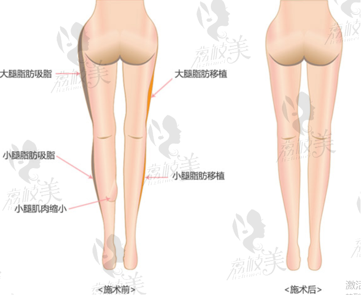 韩国JS美整形外科腿部矫正方案