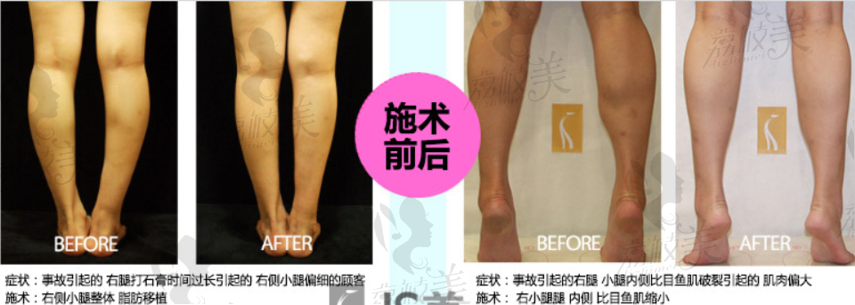 韩国JS美整形外科腿部矫正案例