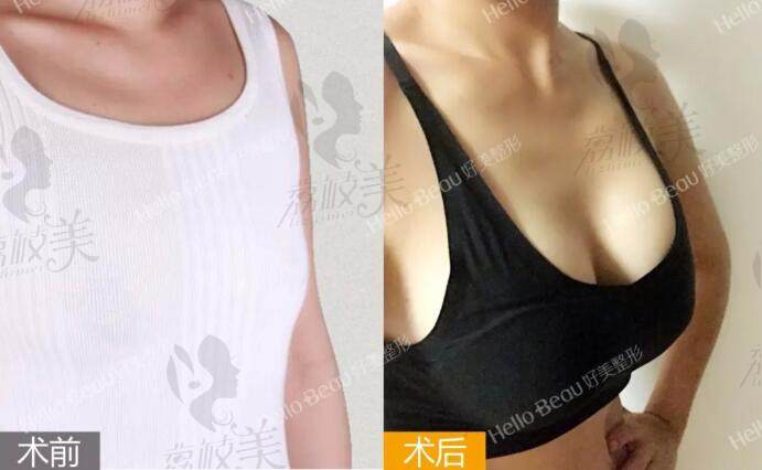 重庆好美找刘正茂院长做美克拉美胸案例