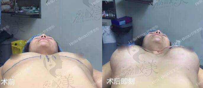 茂院长做美克拉美胸手术即刻