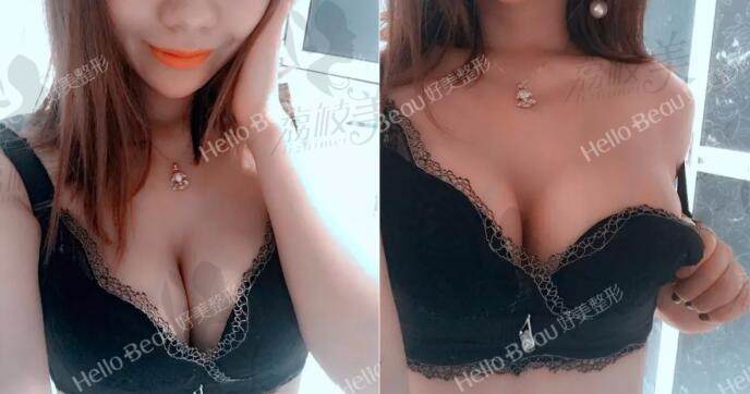 重庆好美刘正茂院长做美克拉美胸术后