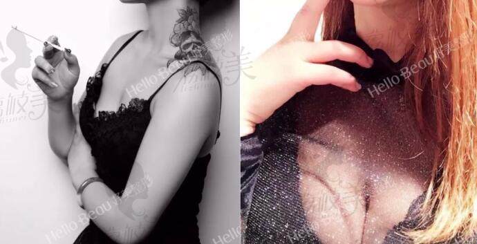 重庆好美找刘正茂院长做美克拉美胸对比