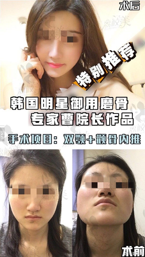 上海美联臣曹栋弼下颌角整形案例