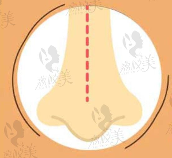 3D达芬奇隆鼻创口