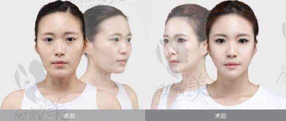 韩国REGEN丽珍整形外科V-line轮廓案例