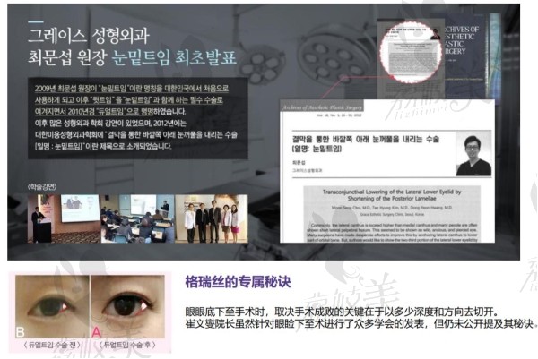 韩国格瑞丝噢爱美整形外科医院魔法眼角项目