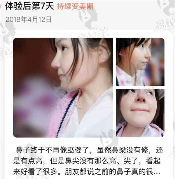 广州博仕医疗美容医院：鼻部修复假体隆鼻修复