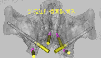 杭州国大口腔邵现红医生种植牙怎么样.png