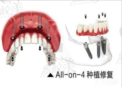 “all-on-4”种植牙示意图