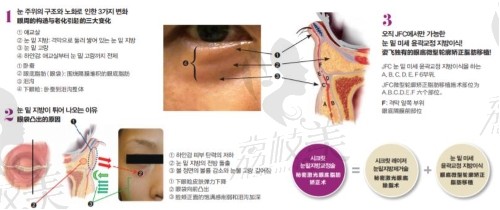 韩国姿飞JF秘密激光眼底除脂术 