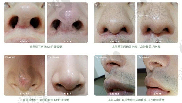 韩国思亲肤乐鼻部祛疤前后对比图
