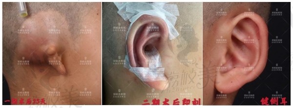 西安国 际整形-郭树忠先天性耳畸形患者