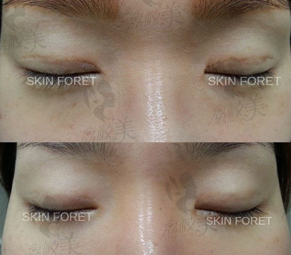 韩国思亲肤乐双眼皮疤痕修复对比图