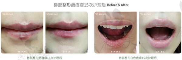 韩国思亲肤乐唇部整形疤痕修复对比图