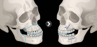 下颌前凸的手术方案