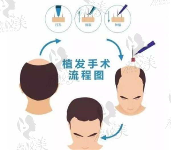 刘医生植发流程简图赏析