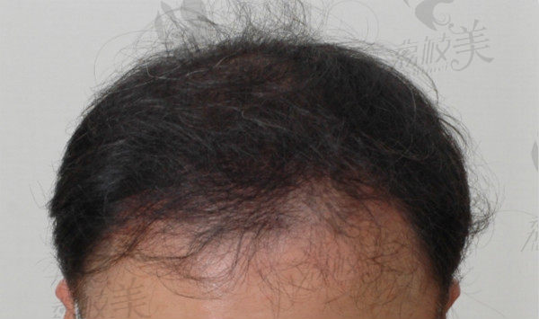 朴泰俊院长的毛发移植术后六个月
