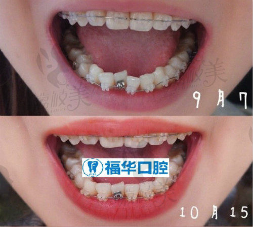 深圳福华口腔矫正牙齿对比图