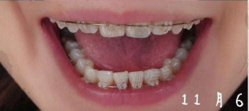 深圳福华口腔矫正牙齿对比图