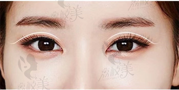 双眼皮修复可以解决哪些问题？