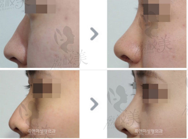 韩国遇见美整形鼻综合恢复过程