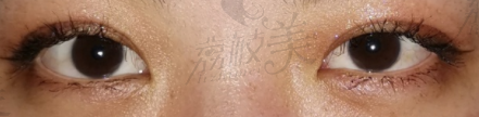 武汉思美妍孔伟埋线双眼皮<span style=