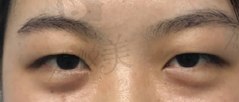 术前肿泡眼.png