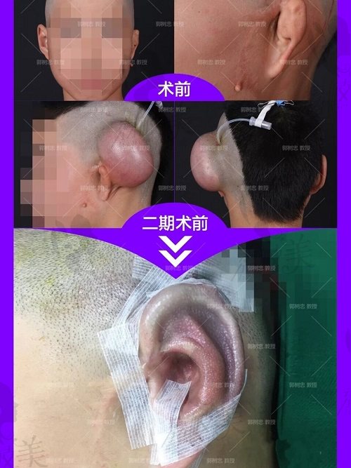 西安国 际医学中心整形医院（郭树忠院长）耳再造术后效果