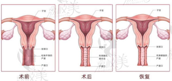 韩国Qline女性医院产道皱成型术