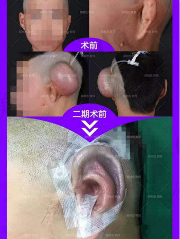 西安国 际医学中心整形医院郭树忠教授耳再造术后效果