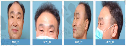 韩国环球美容整形外科医院毛发移植项目介绍