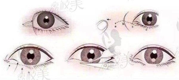 上海星氧医疗美容医院周立亚眼综合项目