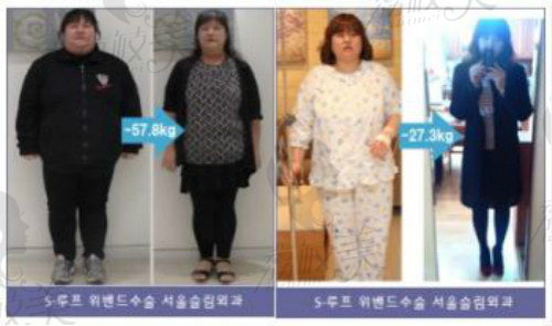 韩国首尔slim整形外科医院减肥手术项目效果图