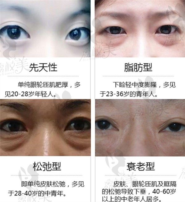 广西爱思特韩国青春祛眼袋技术可解决的眼部问题