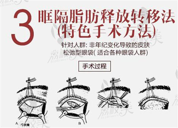 广西爱思特韩国青春祛眼袋技术眼眶脂肪释放法