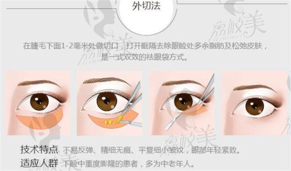 广西爱思特韩国青春祛眼袋技术外切法