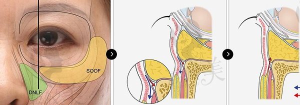 韓國大眼睛下眼瞼術手術方法