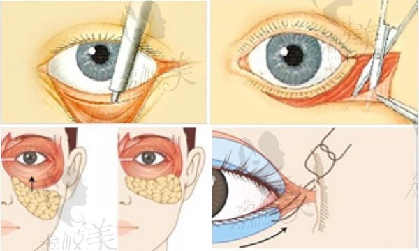 韩国bio下眼睑提升手术方法