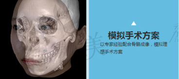 上海時光何晉龍做3d顴骨縮小手術技術穩(wěn)不穩(wěn).png