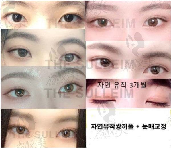 韩国心动整形林柱焕双眼皮修复过程