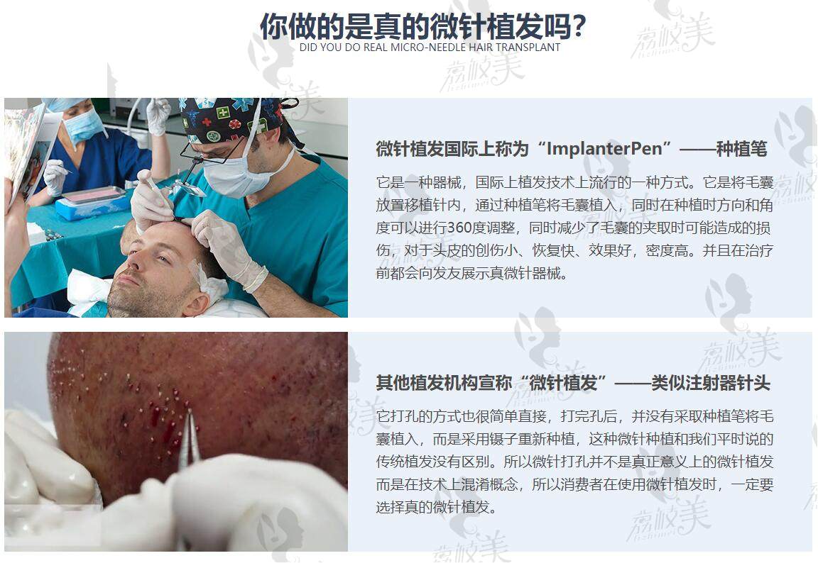 北京大麦微针植发医院植发技术好不好