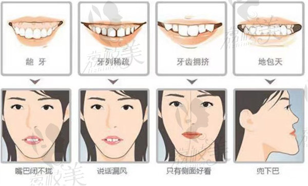 常见的几种需要矫正的牙齿