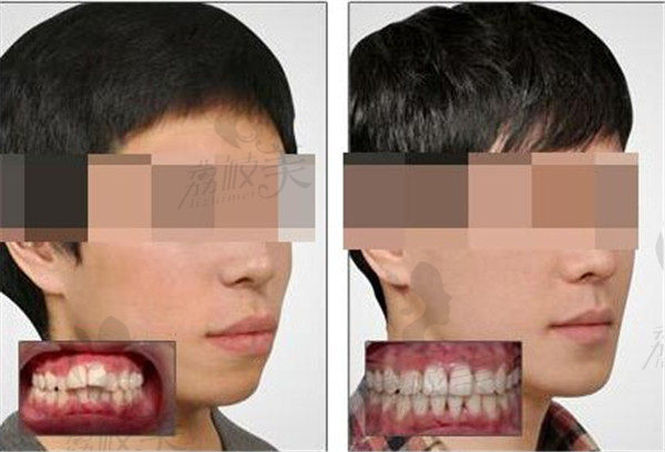 西安米兰柏羽青少年时代天使隐形矫正牙齿效果