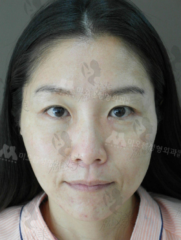 韩国美思科MIOREUM埋线提升+眼底脂肪重排术前